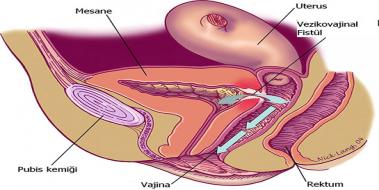 Vajinadan Kan Gelmesi